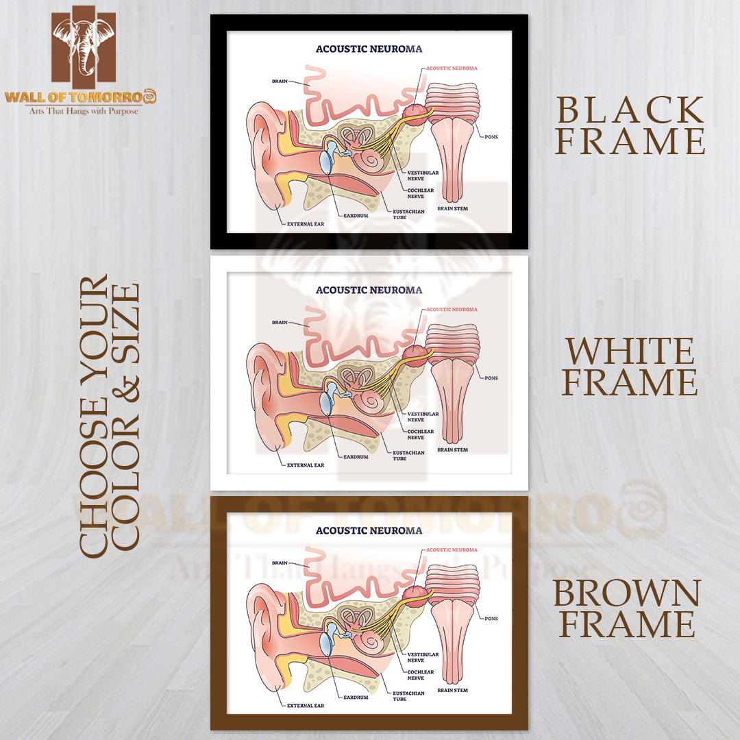 Acoustic Neuroma as Benign Tumor Near Vestibular Nerve Outline Diagram Educational High Quality Glass Frame Wall Décor
