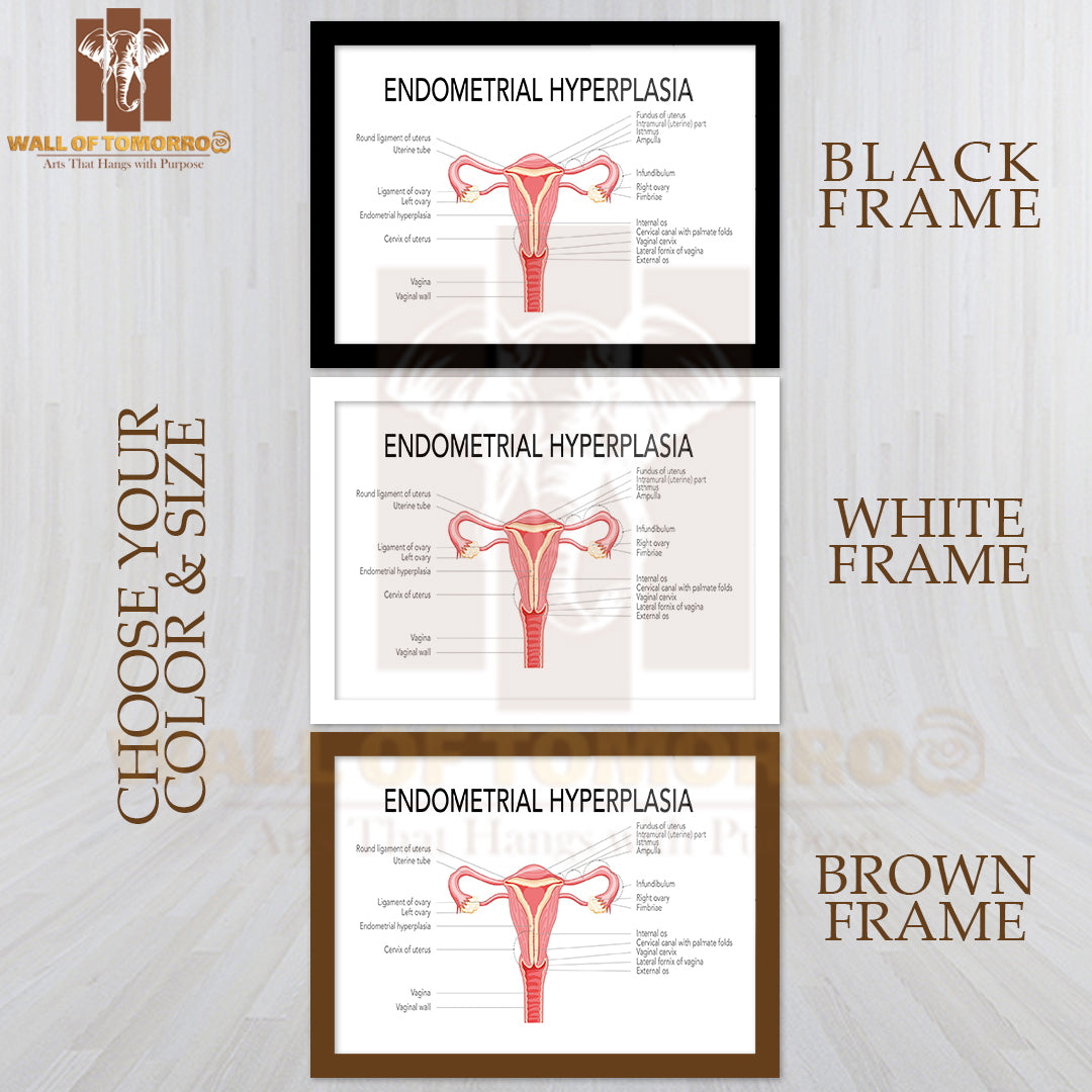 Endometrial Hyperplasia Female Reproductive System Uterus with Inscriptions Medical Diagram Educational High Quality Glass Frame Wall Décor