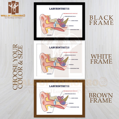 Labyrinthitis As Inner Ear Infection and Medical Inflammation Outline Diagram Educational High Quality Glass Frame Wall Décor