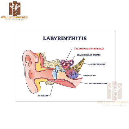 Labyrinthitis As Inner Ear Infection and Medical Inflammation Outline Diagram Educational High Quality Unframed Poster Print & Waterproof Poster Print Wall Décor