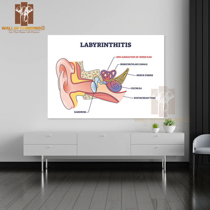 Labyrinthitis As Inner Ear Infection and Medical Inflammation Outline Diagram Educational High Quality Unframed Poster Print & Waterproof Poster Print Wall Décor