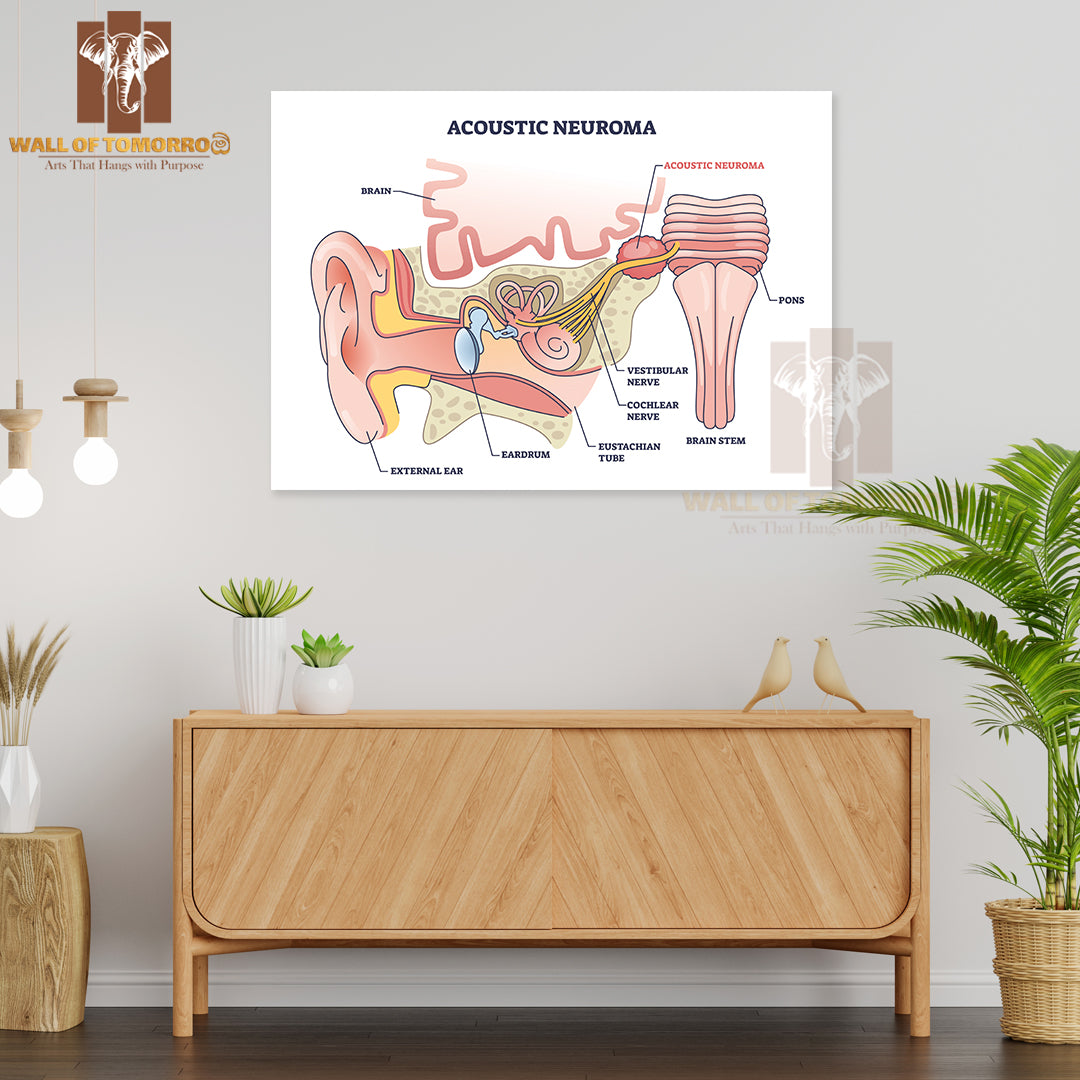 Acoustic Neuroma as Benign Tumor Near Vestibular Nerve Outline Diagram Educational High Quality Unframed Poster Print & Waterproof Poster Print Wall Décor