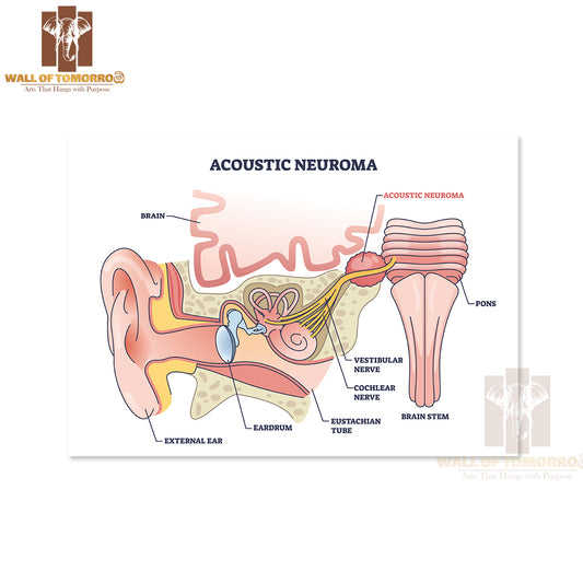 Acoustic Neuroma as Benign Tumor Near Vestibular Nerve Outline Diagram Educational High Quality Unframed Poster Print & Waterproof Poster Print Wall Décor