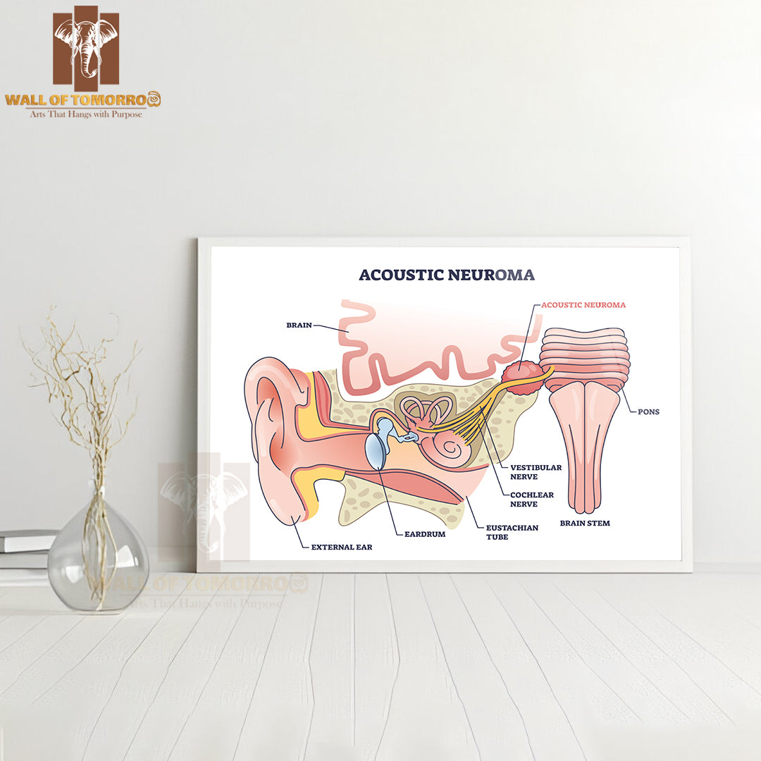 Acoustic Neuroma as Benign Tumor Near Vestibular Nerve Outline Diagram Educational High Quality Glass Frame Wall Décor