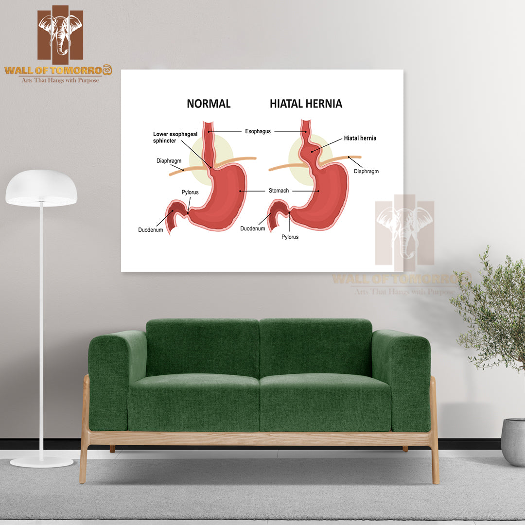 Hiatal Hernia and Normal Anatomy of The Stomach Educational High Quality Unframed Poster Print & Waterproof Poster Print Wall Décor