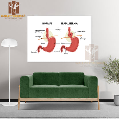 Hiatal Hernia and Normal Anatomy of The Stomach Educational High Quality Unframed Poster Print & Waterproof Poster Print Wall Décor