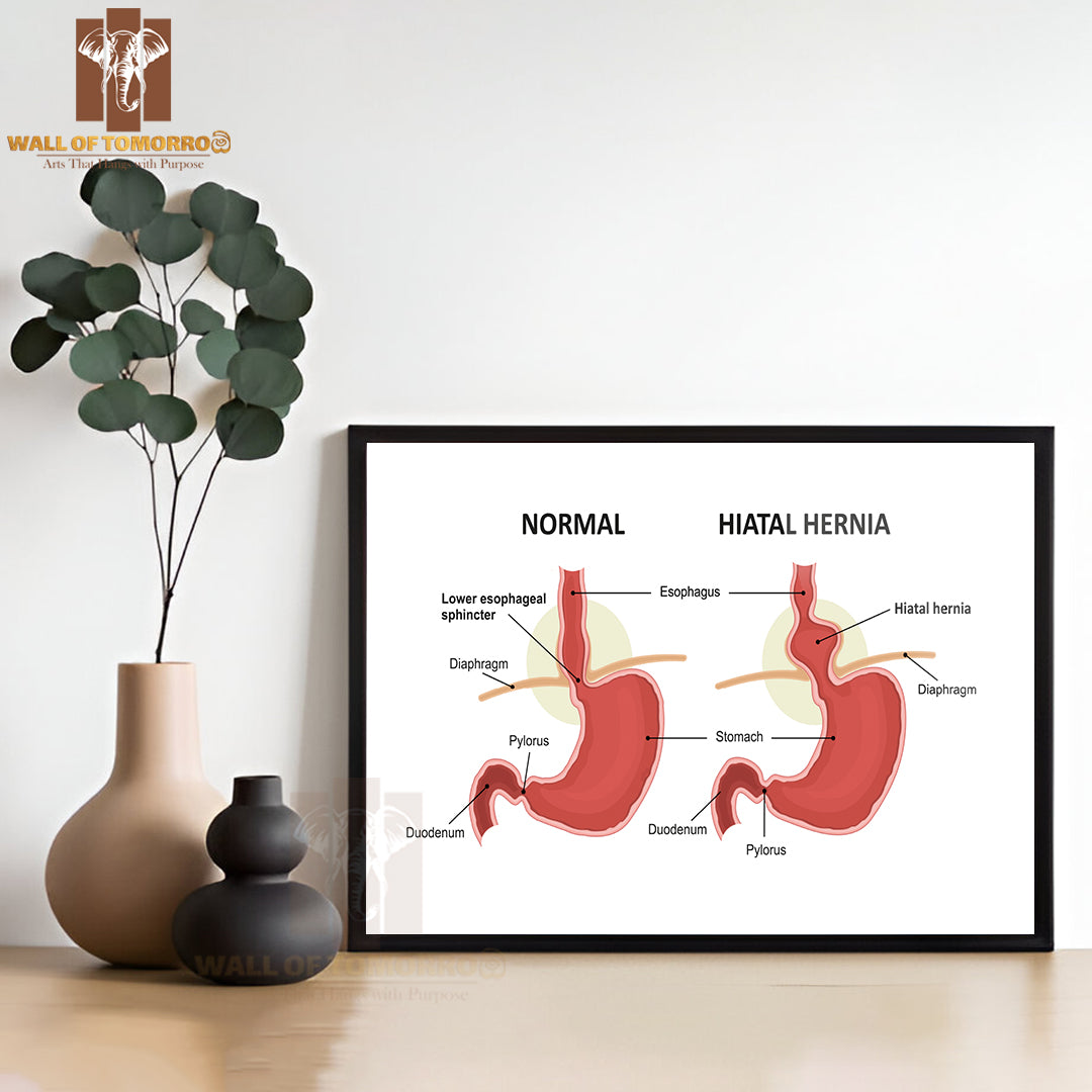 Hiatal Hernia and Normal Anatomy of The Stomach Educational High Quality Glass Frame Wall Décor