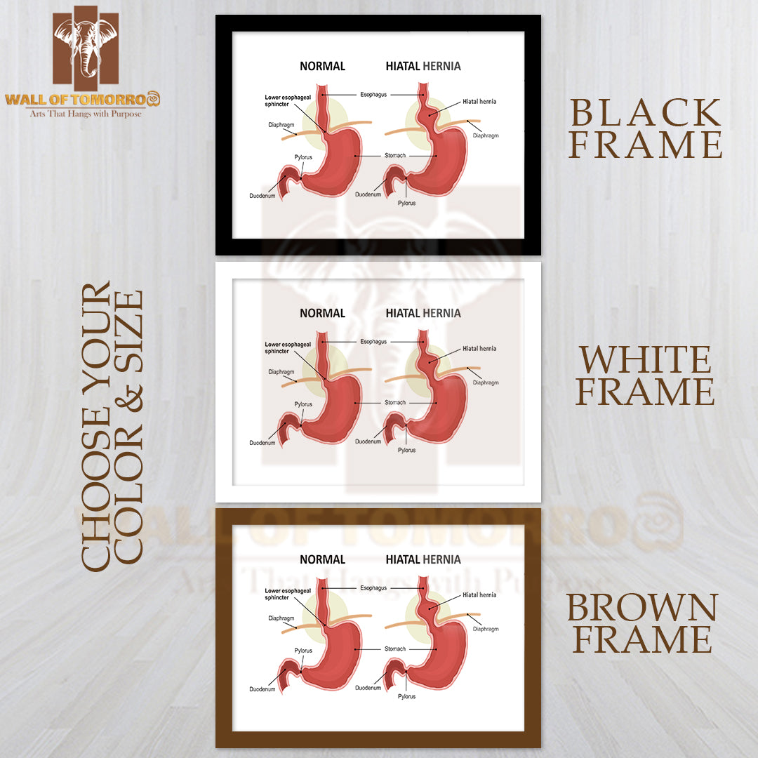 Hiatal Hernia and Normal Anatomy of The Stomach Educational High Quality Glass Frame Wall Décor