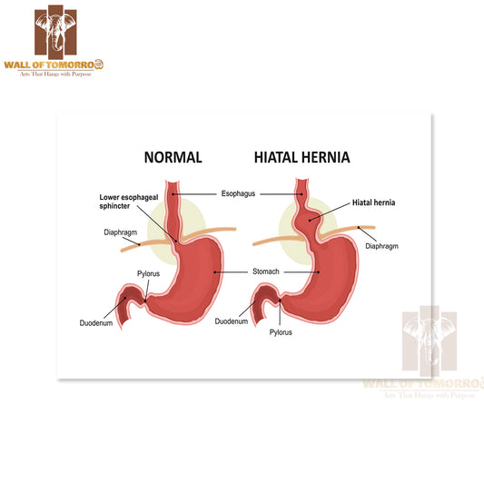 Hiatal Hernia and Normal Anatomy of The Stomach Educational High Quality Unframed Poster Print & Waterproof Poster Print Wall Décor