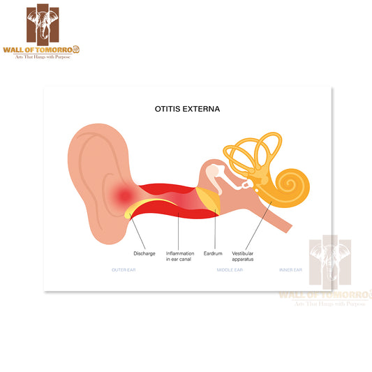 Otitis Externa, Swimmers Ear Disease. Pain And Inflammation, Earache in The Human Head Educational High Quality Unframed Poster Print & Waterproof Poster Print Wall Décor