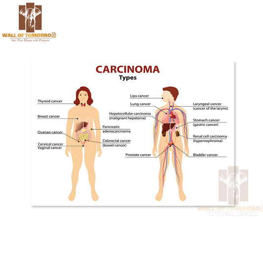 Carcinoma. Type Of Cancer. Woman And Man Silhouette with Highlighted Internal Organs Educational High Quality Unframed Poster Print & Waterproof Poster Print Wall Décor