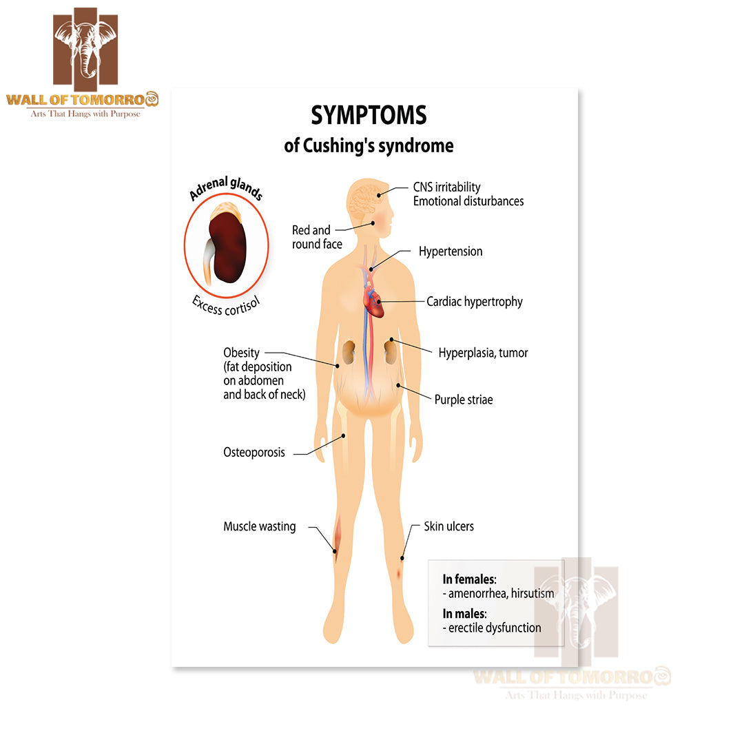 Signs And Symptoms of Cushing's Syndrome. Labeled. Human Silhouette with Internal Organs Educational High Quality Unframed Poster Print & Waterproof Poster Print Wall Décor