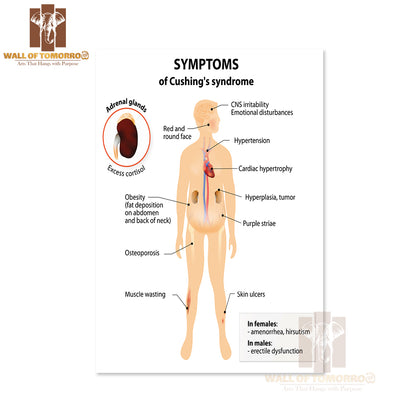 Signs And Symptoms of Cushing's Syndrome. Labeled. Human Silhouette with Internal Organs Educational High Quality Unframed Poster Print & Waterproof Poster Print Wall Décor