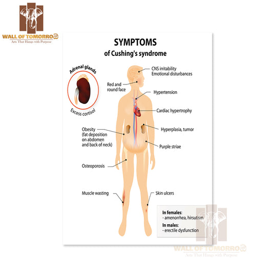 Signs And Symptoms of Cushing's Syndrome. Labeled. Human Silhouette with Internal Organs Educational High Quality Unframed Poster Print & Waterproof Poster Print Wall Décor