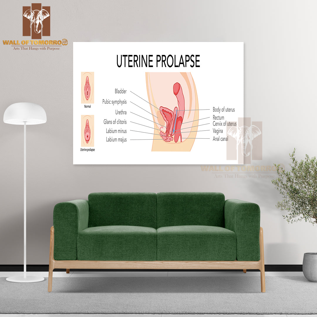 Set Of Uterine Prolapse Female Reproductive System Uterus Labeled in Anatomical Infographic Educational High Quality Unframed Poster Print & Waterproof Poster Print Wall Décor