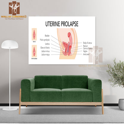 Set Of Uterine Prolapse Female Reproductive System Uterus Labeled in Anatomical Infographic Educational High Quality Unframed Poster Print & Waterproof Poster Print Wall Décor