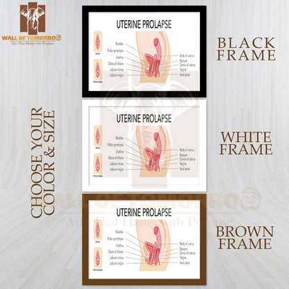 Set Of Uterine Prolapse Female Reproductive System Uterus Labeled in Anatomical Infographic Educational High Quality Glass Frame Wall Décor