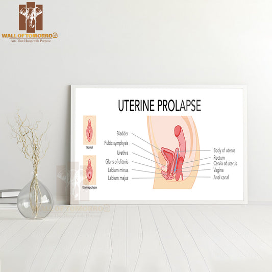 Set Of Uterine Prolapse Female Reproductive System Uterus Labeled in Anatomical Infographic Educational High Quality Glass Frame Wall Décor