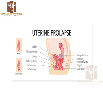 Set Of Uterine Prolapse Female Reproductive System Uterus Labeled in Anatomical Infographic Educational High Quality Unframed Poster Print & Waterproof Poster Print Wall Décor