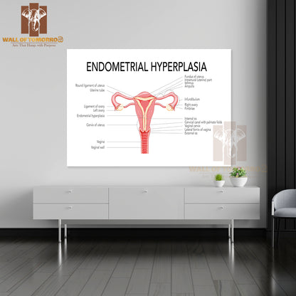 Endometrial Hyperplasia Female Reproductive System Uterus with Inscriptions Medical Diagram Educational High Quality Unframed Poster Print & Waterproof Poster Print Wall Décor