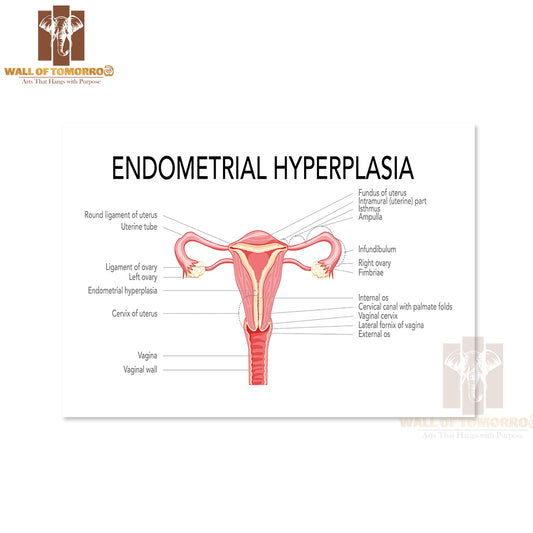 Endometrial Hyperplasia Female Reproductive System Uterus with Inscriptions Medical Diagram Educational High Quality Unframed Poster Print & Waterproof Poster Print Wall Décor