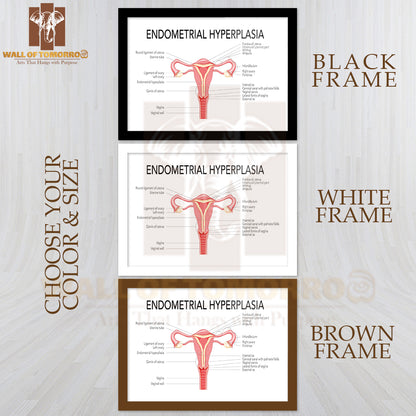 Endometrial Hyperplasia Female Reproductive System Uterus with Inscriptions Medical Diagram Educational High Quality Glass Frame Wall Décor
