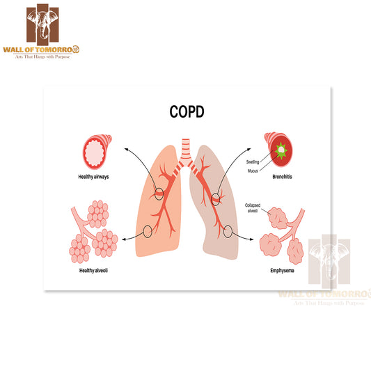 Chronic Obstructive Pulmonary Disease or COPD Educational High Quality Unframed Poster Print & Waterproof Poster Print Wall Décor