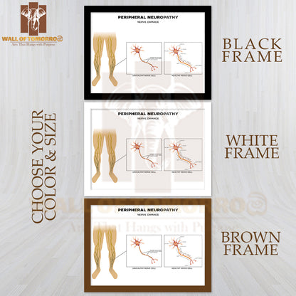 Neuropathy, Damage of Peripheral Nerves. Pain And Loss of Sensation in The Extremities Educational High Quality Glass Frame Wall Décor