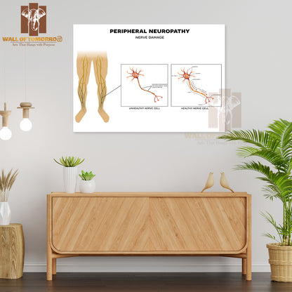 Neuropathy, Damage of Peripheral Nerves. Pain And Loss of Sensation in The Extremities Educational High Quality Unframed Poster Print & Waterproof Poster Print Wall Décor
