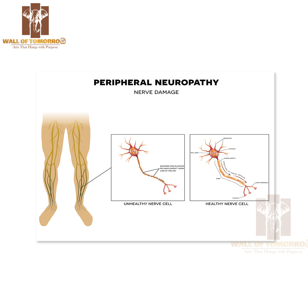 Neuropathy, Damage of Peripheral Nerves. Pain And Loss of Sensation in The Extremities Educational High Quality Unframed Poster Print & Waterproof Poster Print Wall Décor
