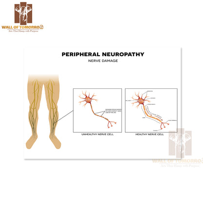 Neuropathy, Damage of Peripheral Nerves. Pain And Loss of Sensation in The Extremities Educational High Quality Unframed Poster Print & Waterproof Poster Print Wall Décor
