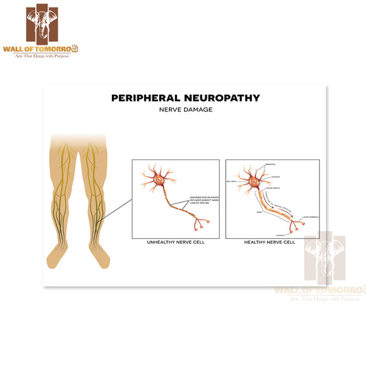 Neuropathy, Damage of Peripheral Nerves. Pain And Loss of Sensation in The Extremities Educational High Quality Unframed Poster Print & Waterproof Poster Print Wall Décor