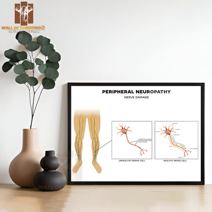 Neuropathy, Damage of Peripheral Nerves. Pain And Loss of Sensation in The Extremities Educational High Quality Glass Frame Wall Décor