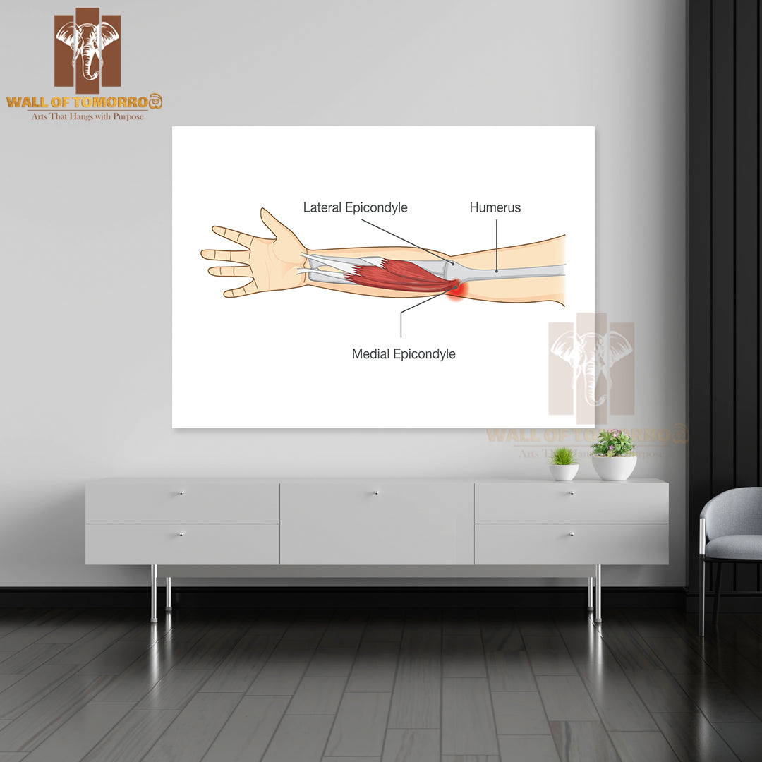 Muscle Injury and Tear in Tendon at Elbow Area from Twisting and Motions Educational High Quality Unframed Poster Print & Waterproof Poster Print Wall Décor