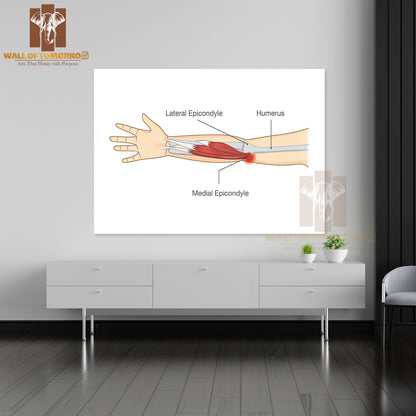 Muscle Injury and Tear in Tendon at Elbow Area from Twisting and Motions Educational High Quality Unframed Poster Print & Waterproof Poster Print Wall Décor