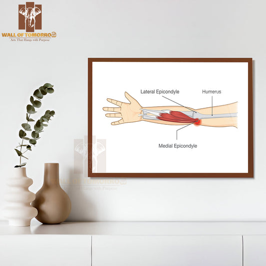 Muscle Injury and Tear in Tendon at Elbow Area from Twisting and Motions Educational High Quality Glass Frame Wall Décor