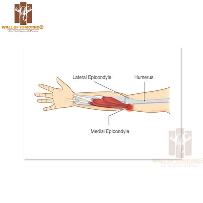 Muscle Injury and Tear in Tendon at Elbow Area from Twisting and Motions Educational High Quality Unframed Poster Print & Waterproof Poster Print Wall Décor