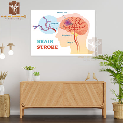 Diagram, Scheme with Brains Blood Flow and Blood Clot Educational High Quality Unframed Poster Print & Waterproof Poster Print Wall Décor