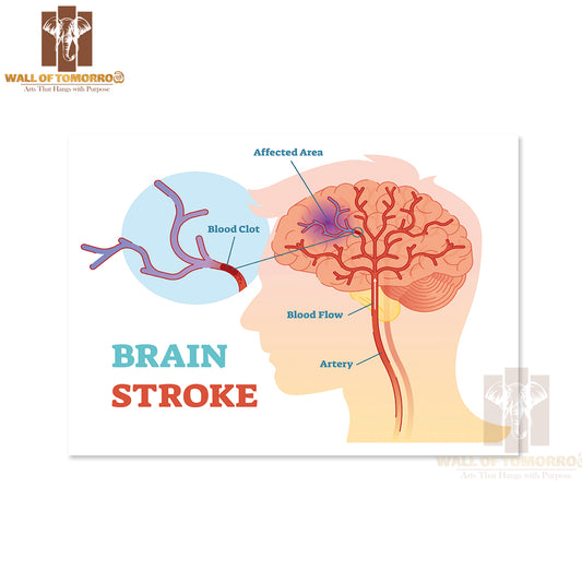 Diagram, Scheme with Brains Blood Flow and Blood Clot Educational Educational High Quality Unframed Poster Print & Waterproof Poster Print Wall Décor